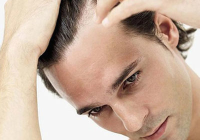 What Should You Do When Selecting Hair Loss Treatment